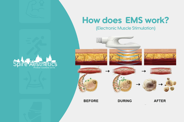 EMS treatment for post pregnancy weight loss treatment Craigmillar