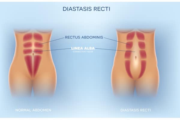 What Non-Surgical Options Are Available for Diastasis Recti Craigmillar?