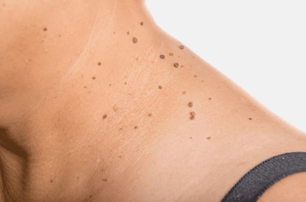 Are you looking for easy skin tag removal Craigmillar - then contact Spire today!