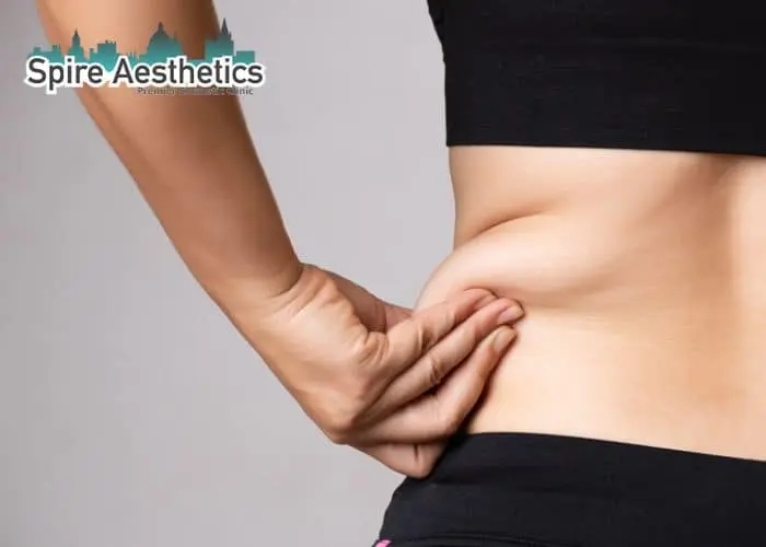 Image of woman pinching fat on their hips Craigmillar. Fat Freezing treatment
