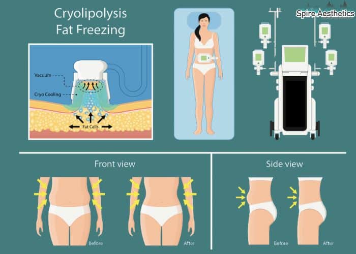 Image of diet and fat freezing combined for best results for Spire Aesthetics Craigmillar