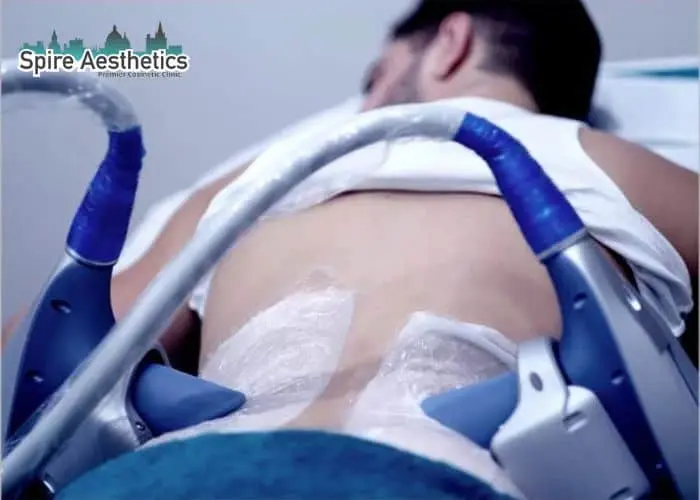 Man having fat freezing treatment done on love handles before a competitions Craigmillar to create a sculpted look.