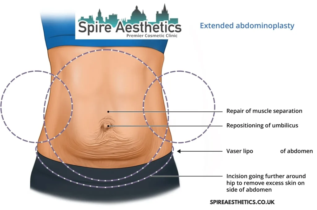 Understanding Loose Skin After Gastric Band Craigmillar Surgery and HIFU Treatment