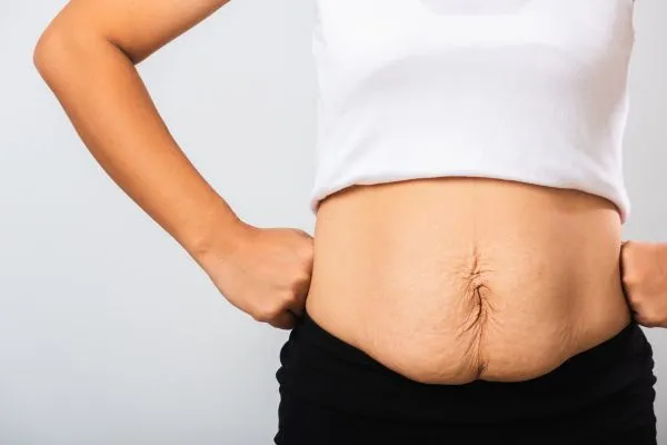 Image of a woman's stomach after weight loss with sagging skin following a gastric band Craigmillar