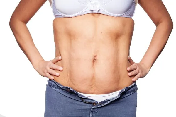 sagging skin on woman's stomach after weight loss injections Craigmillar