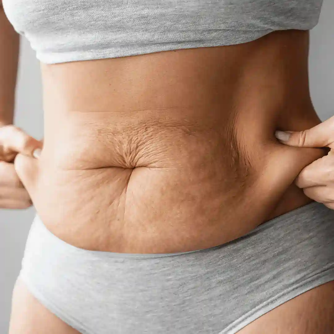 Is It Normal to Have Loose Skin After Pregnancy Craigmillar?